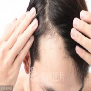 那些防脱“妙招” 能帮你守住发际线吗