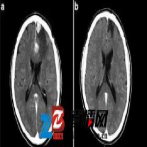 瑞典新型DC细胞药物试验效果佳，可延长肾细胞癌患者近3年寿命