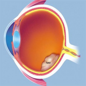 中因科技：推动遗传性眼病基因检测的发展