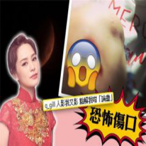 阿娇为拍月食摔跤 膝盖受伤网友心疼