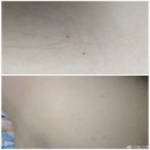 甘肃一幼儿园被曝针扎孩子 警方疑让园方拿钱摆平