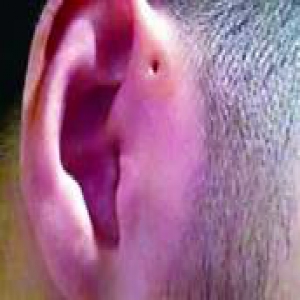 耳旁小洞是啥器官进化残留