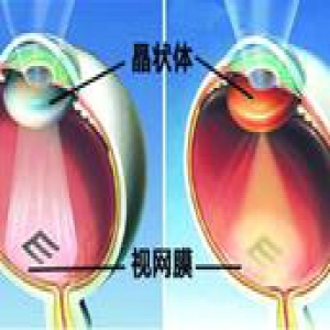 当糖尿病人同时患有白内障怎么办