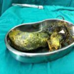 初二女生因压力大致异食癖 吃头发把胃撑到四倍