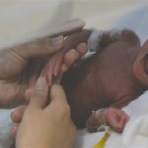 成都“巴掌公主”出生仅1斤4两 等同一瓶矿泉水