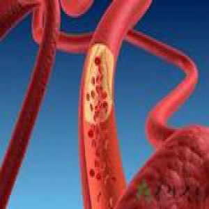 瘦子胆固醇高的原因