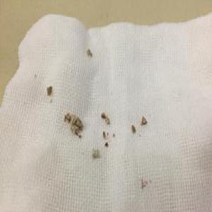 2岁男童每天吃辣条喝乳酸饮料 膀胱长结石