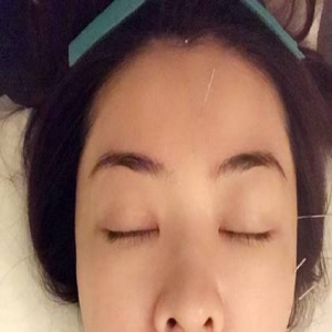 熊黛林满脸扎针，这是什么情况？