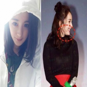 杨幂下巴惊见“突出物”被曝是削骨后遗症