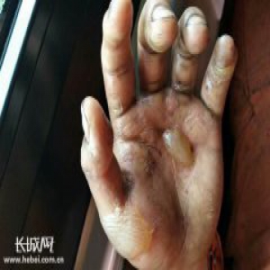 内蒙古火灾淬炼出的军魂：火场一双手 感动百万人